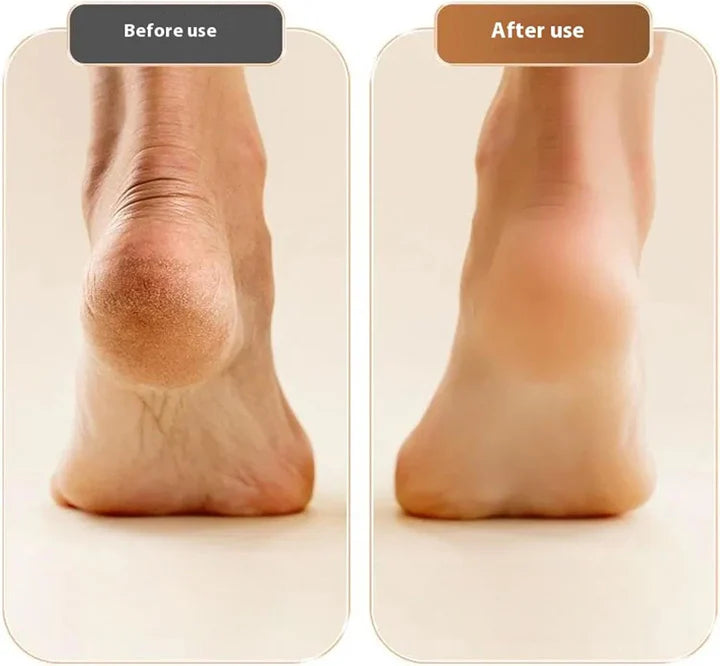 Foot Callus Remover